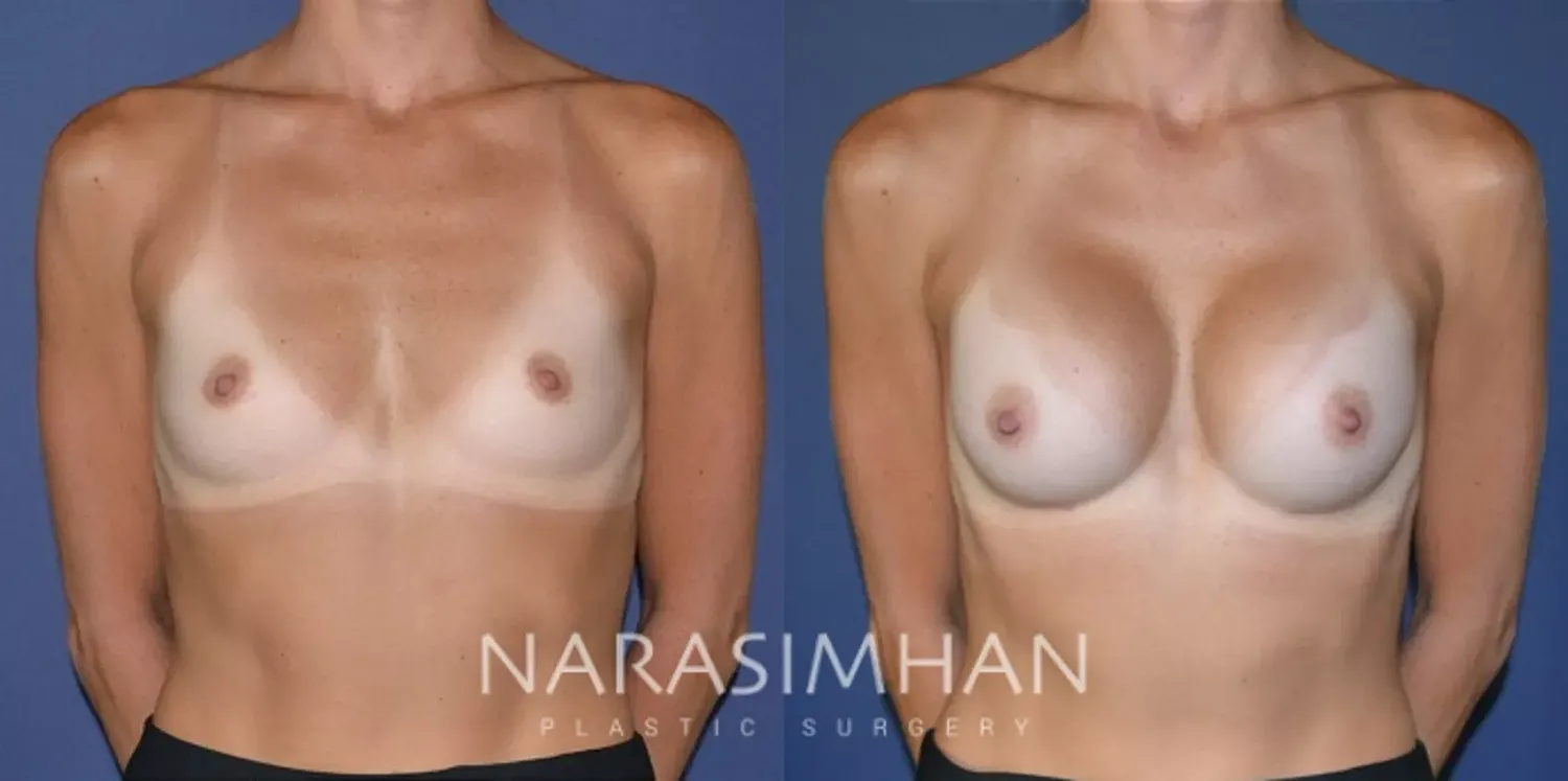 Breast Augmentation Before & After