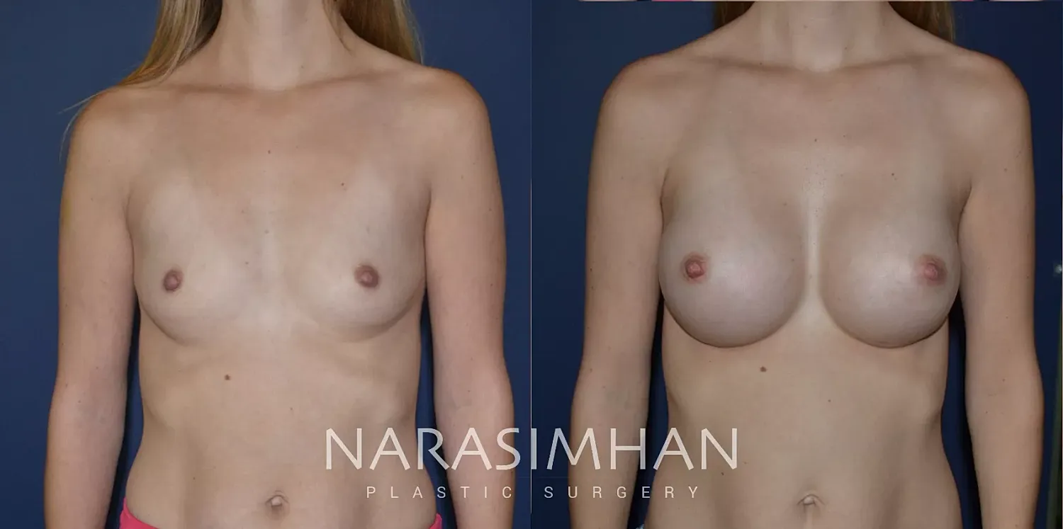 Breast Augmentation Before & After