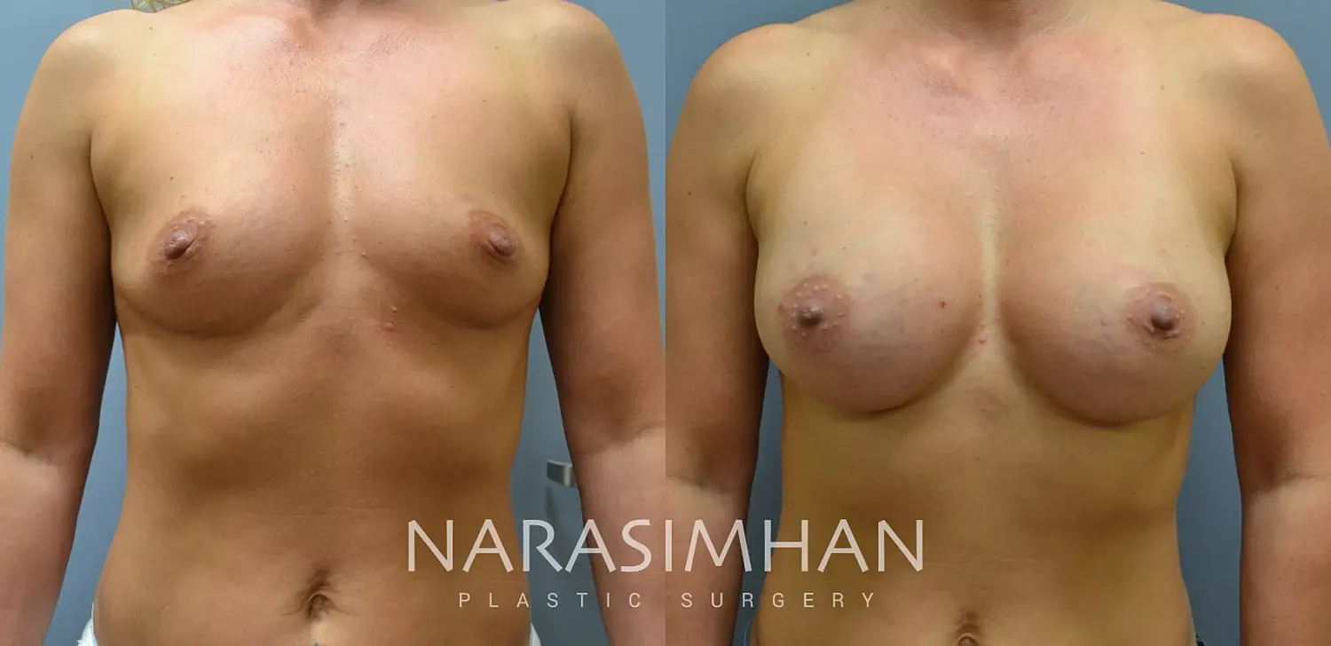 Breast Augmentation Before & After