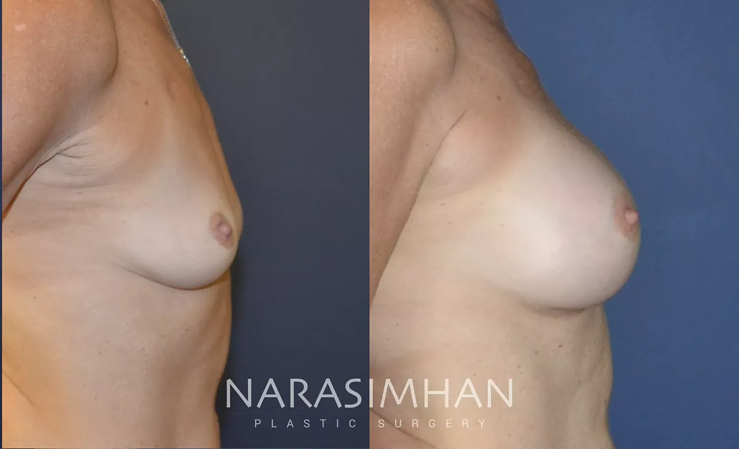 Breast Augmentation Before & After