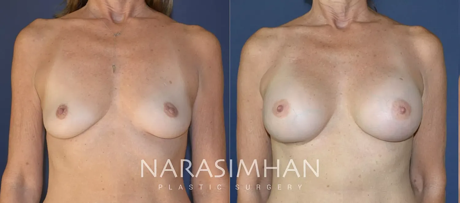 Breast Augmentation Before & After