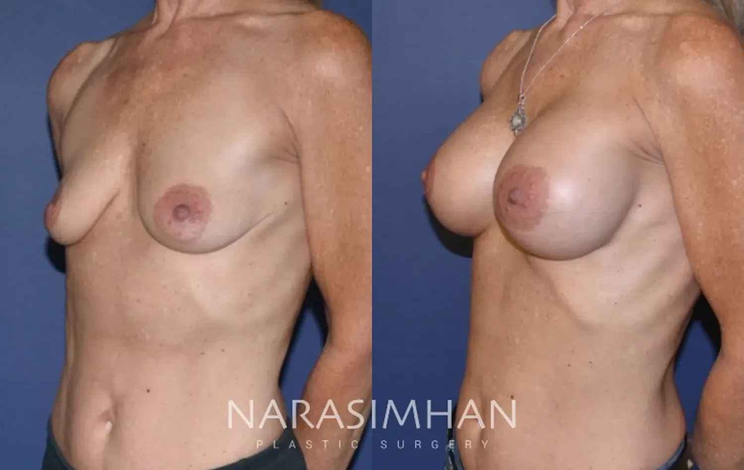 Breast Augmentation Before & After