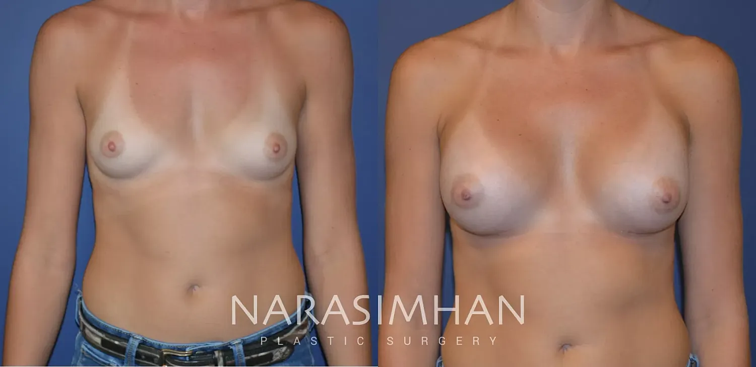 Breast Augmentation Before & After