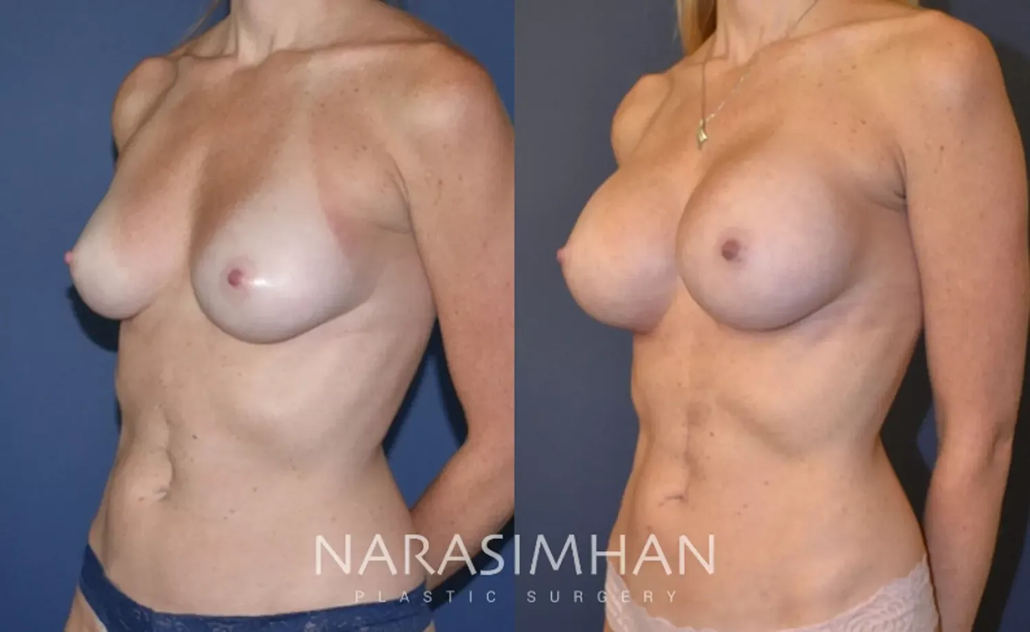Breast Augmentation Before & After