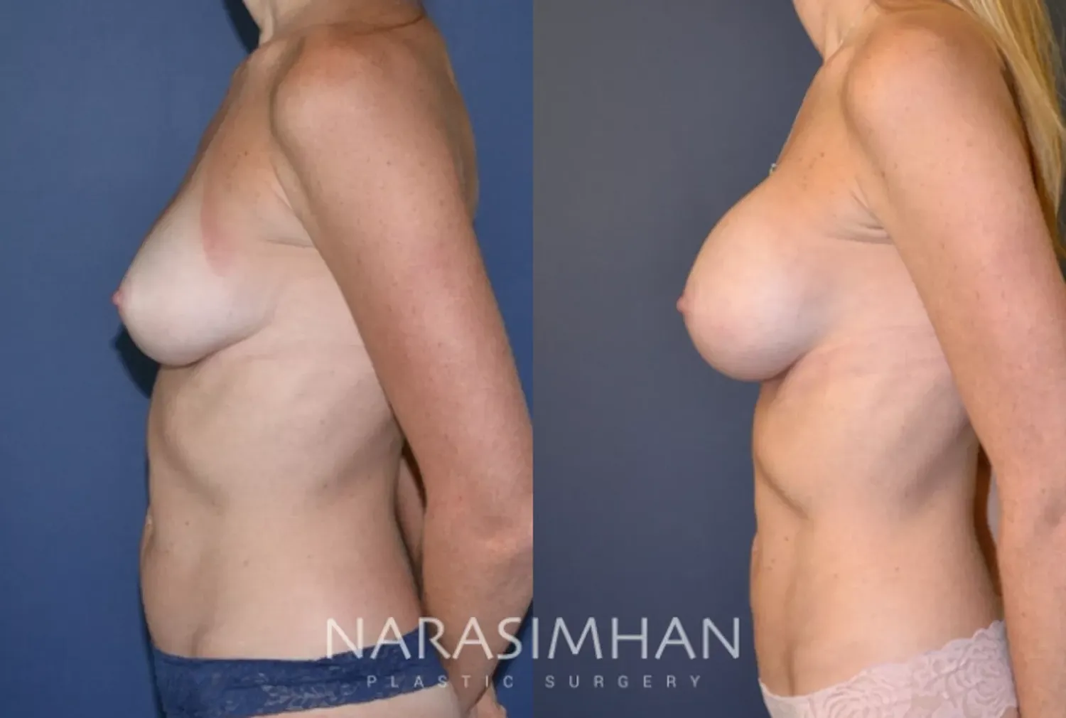 Breast Augmentation Before & After