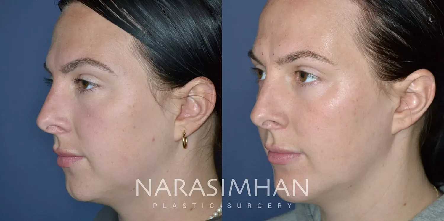 Chin Augmentation Before & After