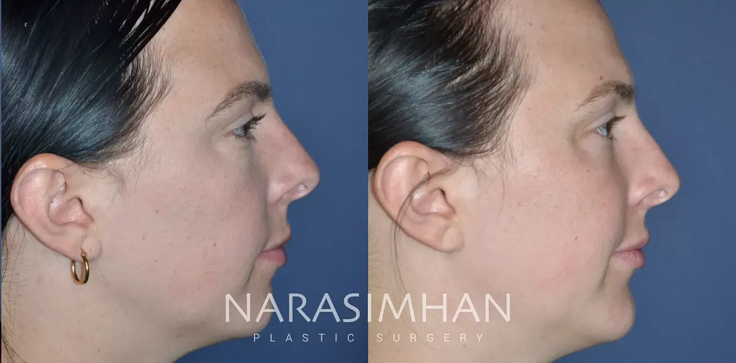 Chin Augmentation Before & After
