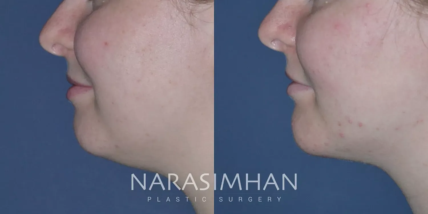 Chin Augmentation Before & After