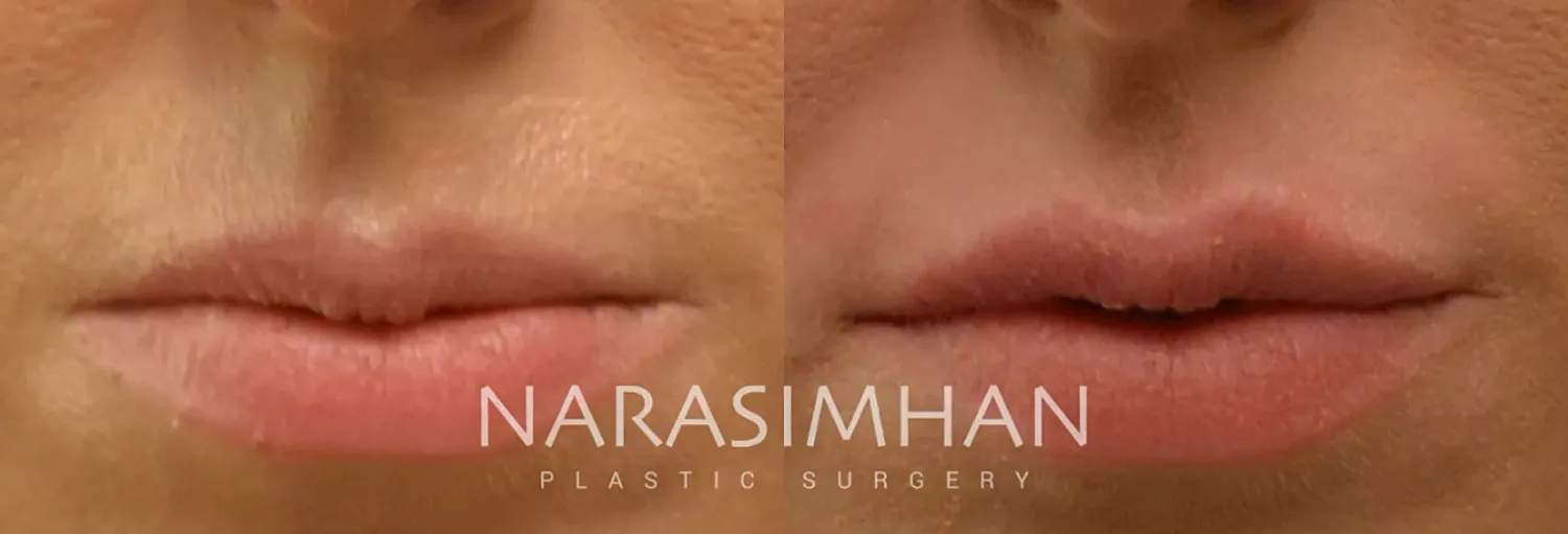 Botox Before & After