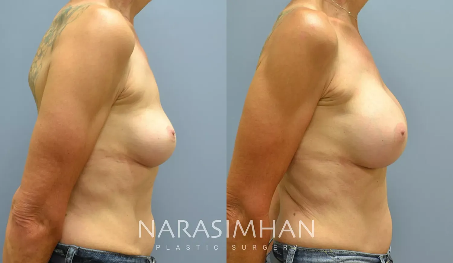 Breast Implant Revision Before & After