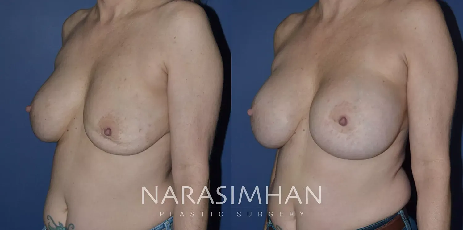 Breast Implant Revision Before & After