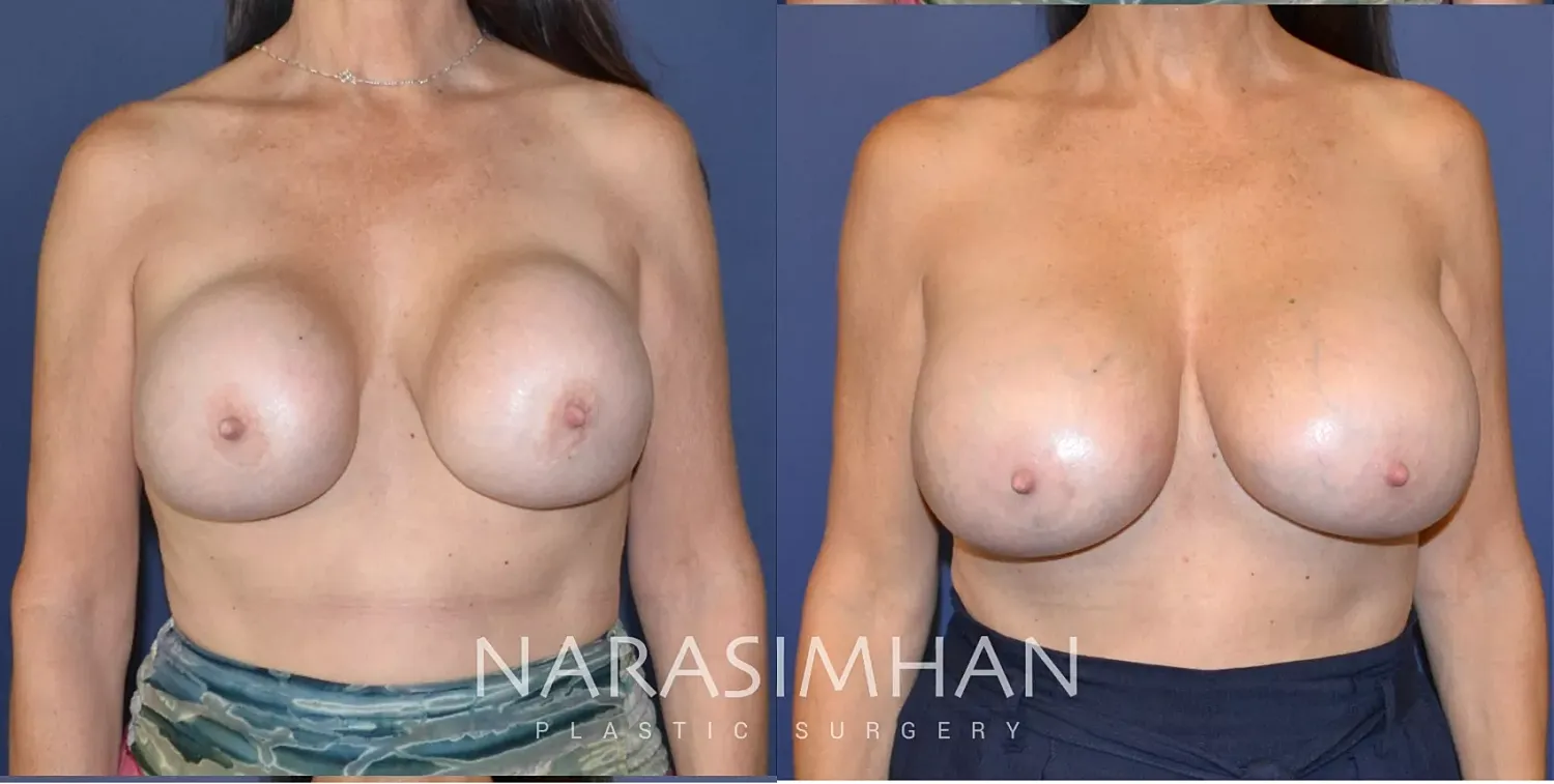 Breast Implant Revision Before & After