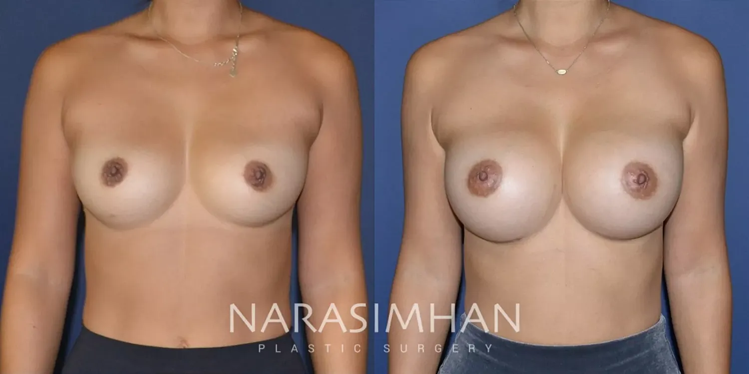 Breast Implant Revision Before & After