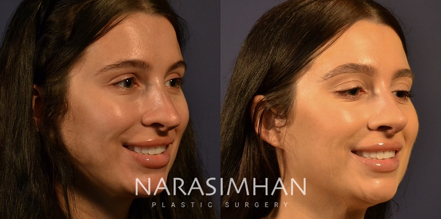 Revision Rhinoplasty Before & After