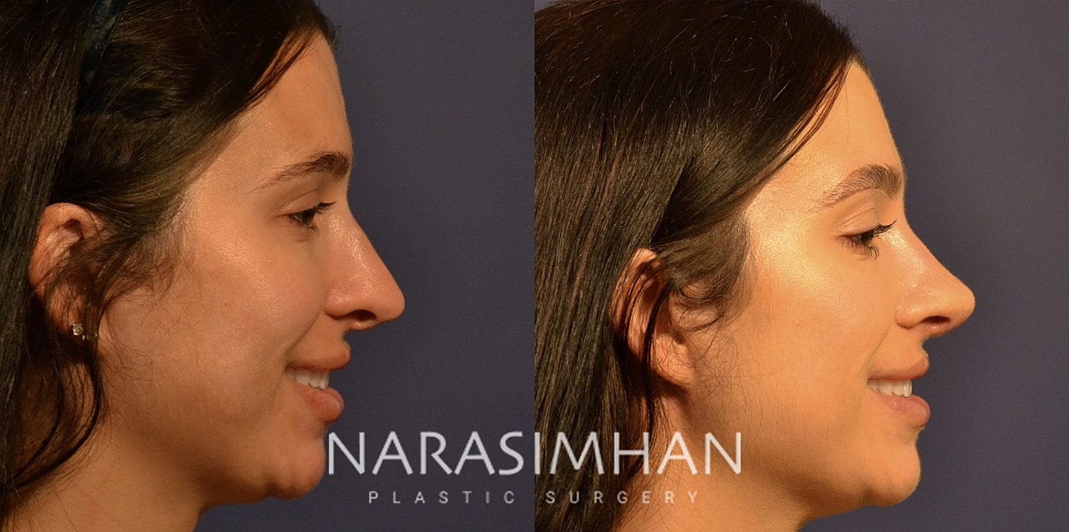 Revision Rhinoplasty Before & After