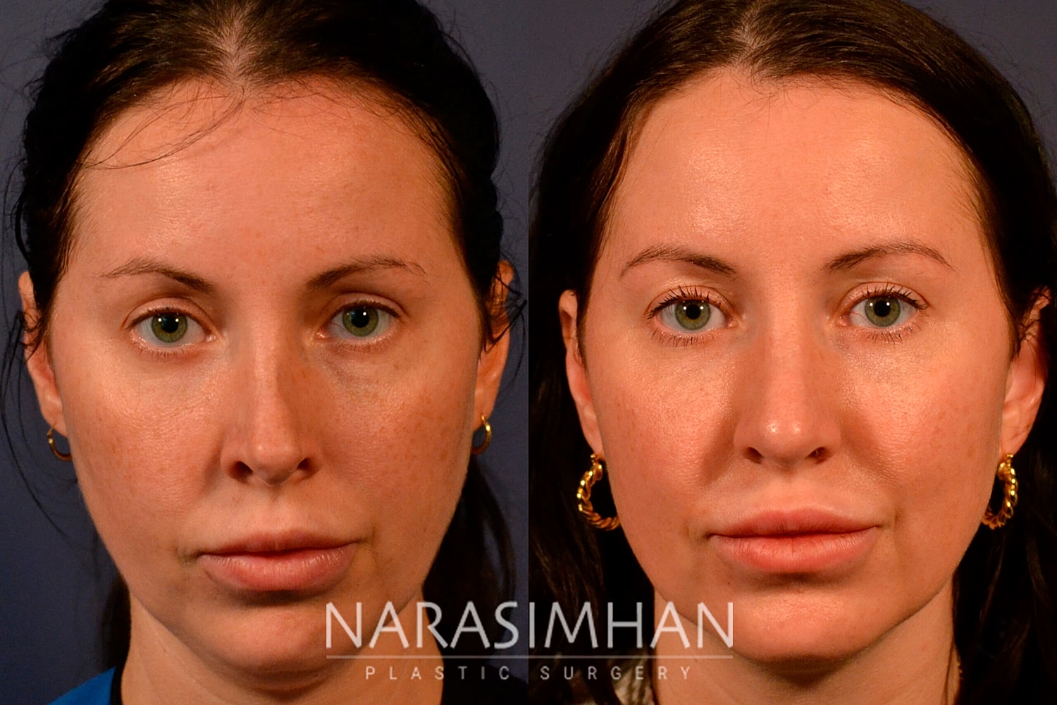 Revision Rhinoplasty Before & After