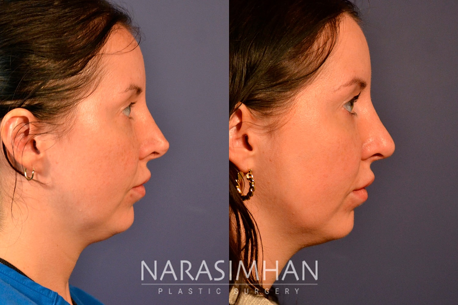 Revision Rhinoplasty Before & After