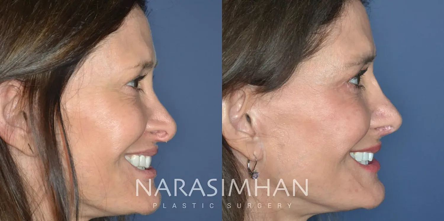 Revision Rhinoplasty Before & After