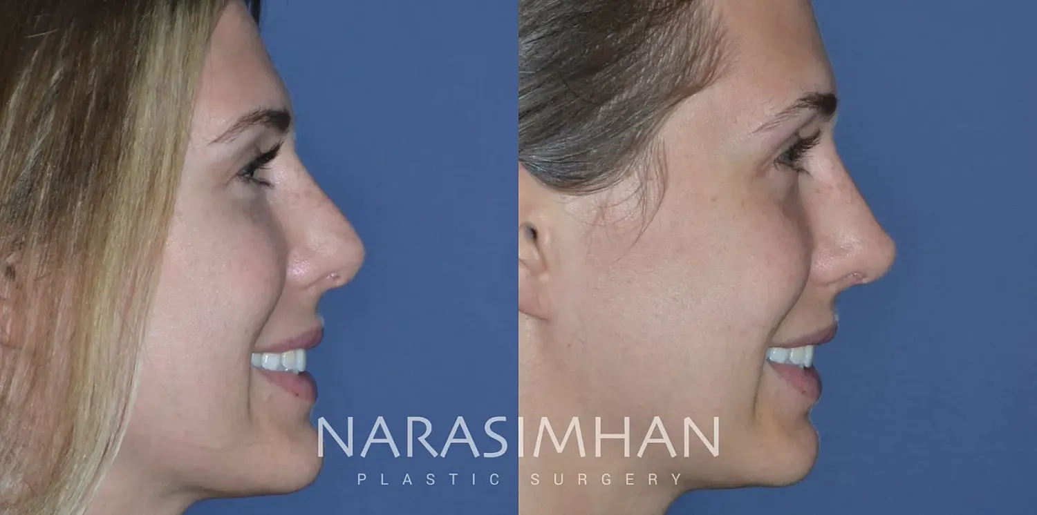 Revision Rhinoplasty Before & After