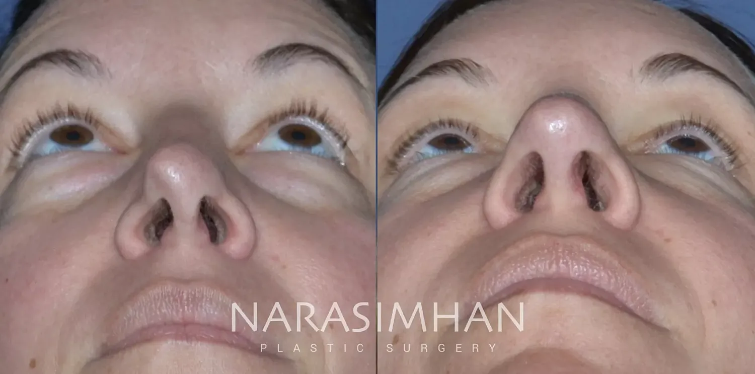 Revision Rhinoplasty Before & After