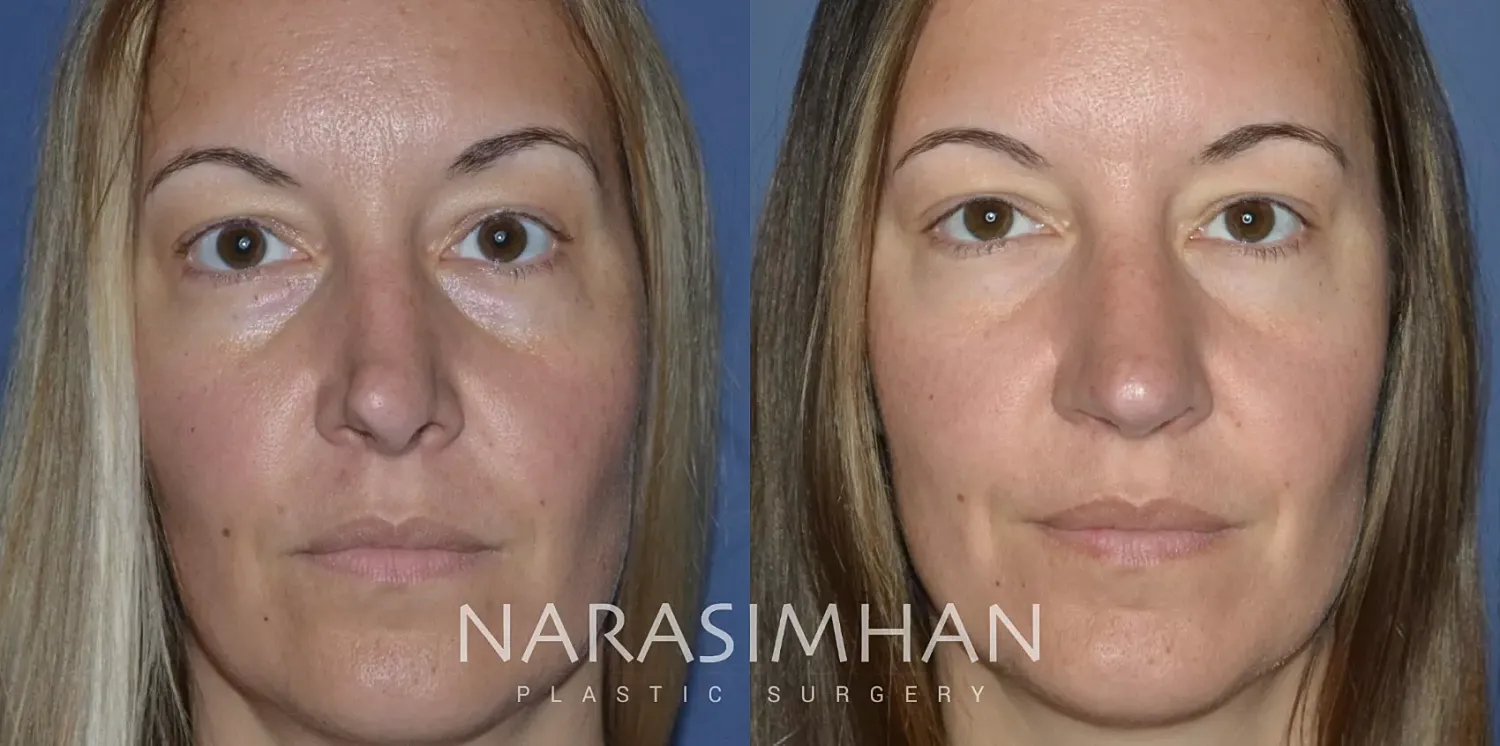 Revision Rhinoplasty Before & After