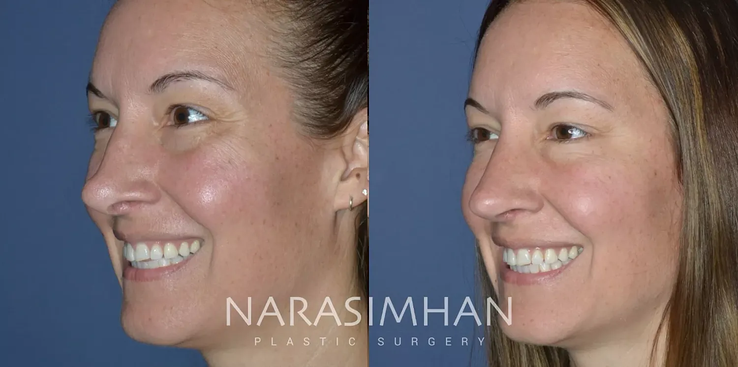 Revision Rhinoplasty Before & After