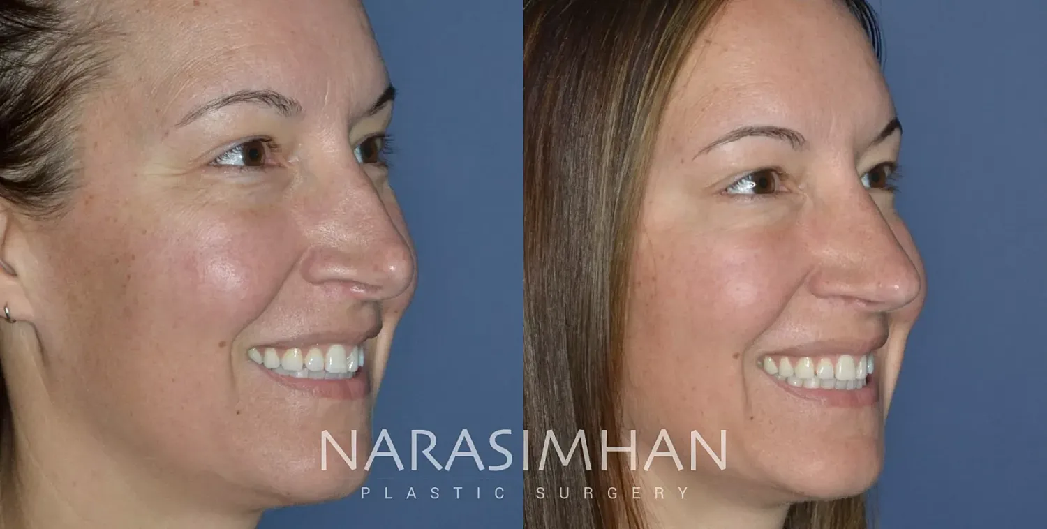Revision Rhinoplasty Before & After