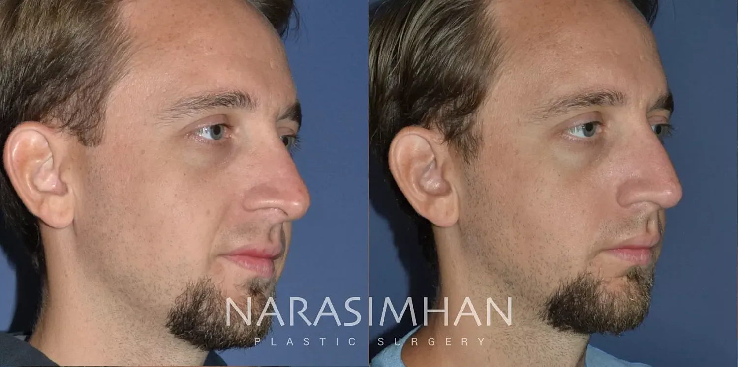 Revision Rhinoplasty Before & After
