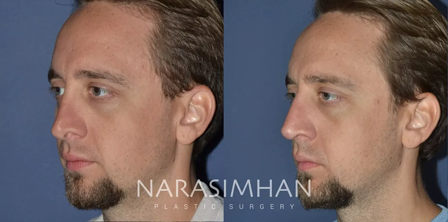 Revision Rhinoplasty Before & After