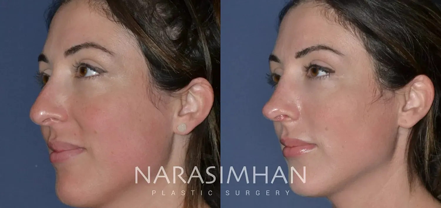 Revision Rhinoplasty Before & After