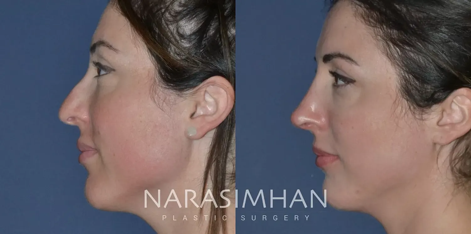 Revision Rhinoplasty Before & After