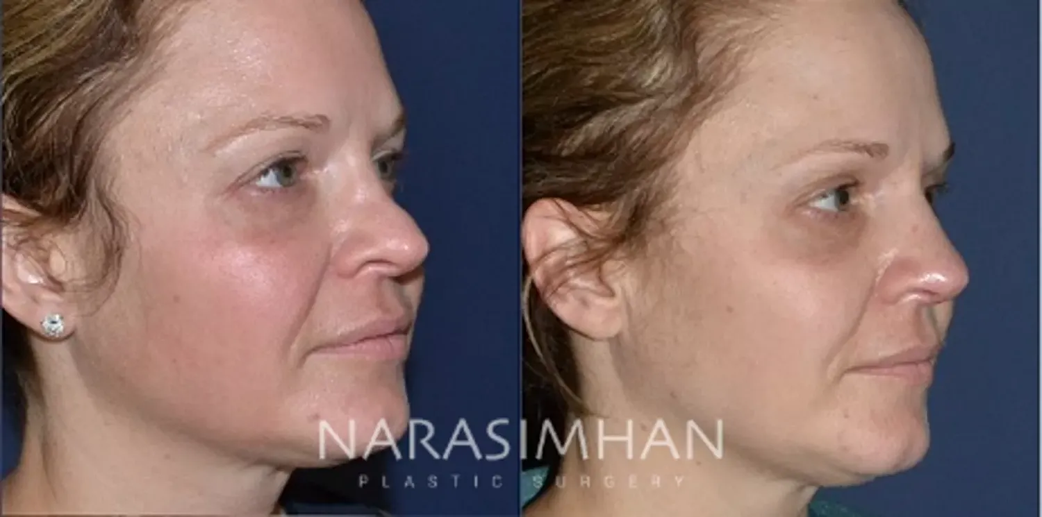Revision Rhinoplasty Before & After