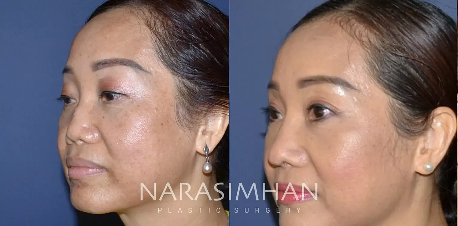 Revision Rhinoplasty Before & After