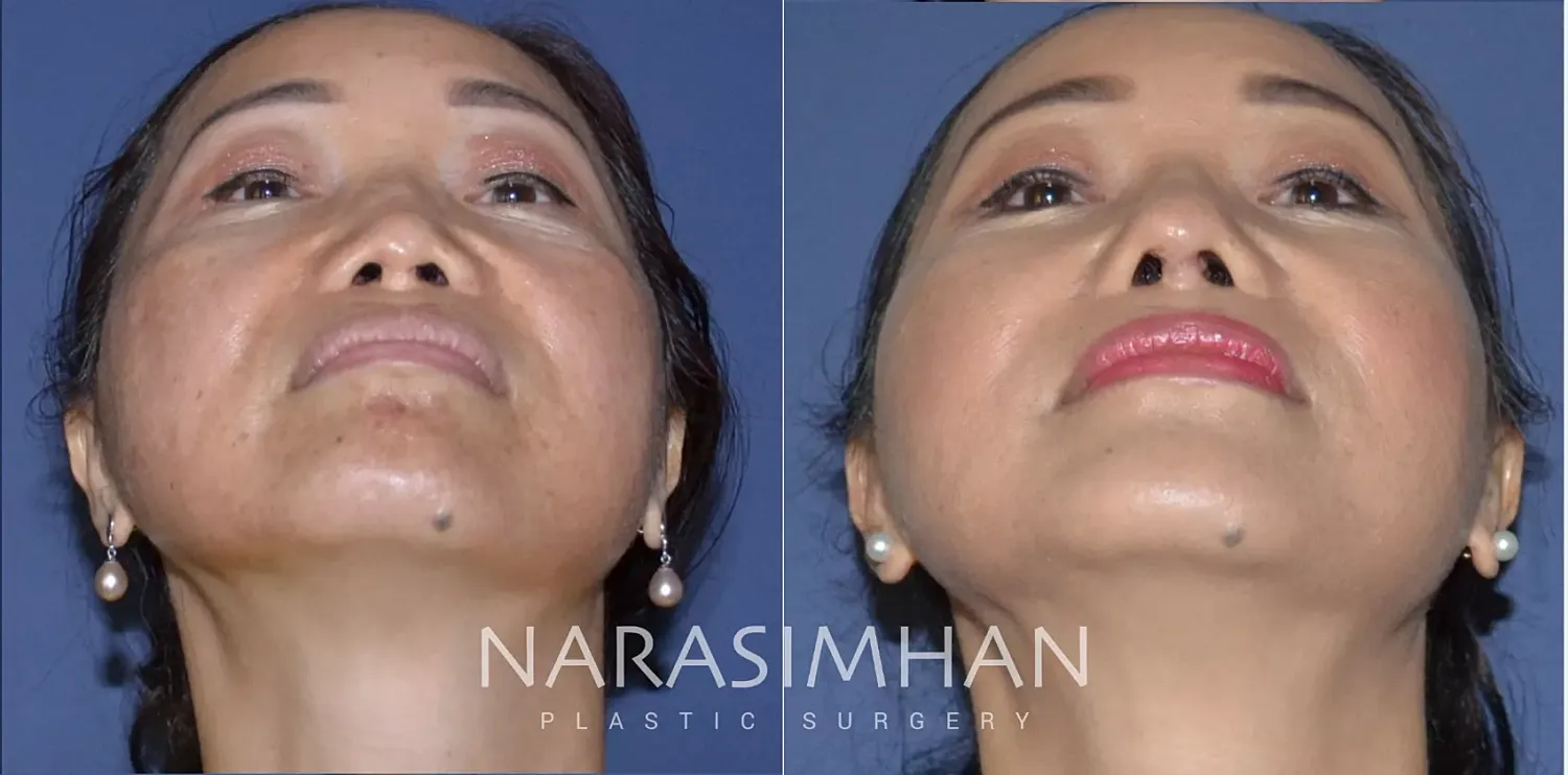 Revision Rhinoplasty Before & After