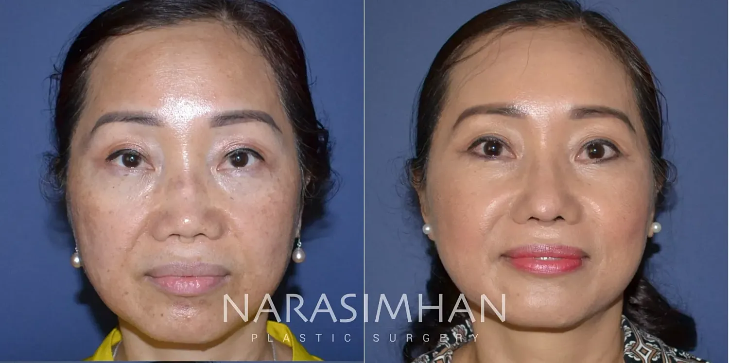 Revision Rhinoplasty Before & After