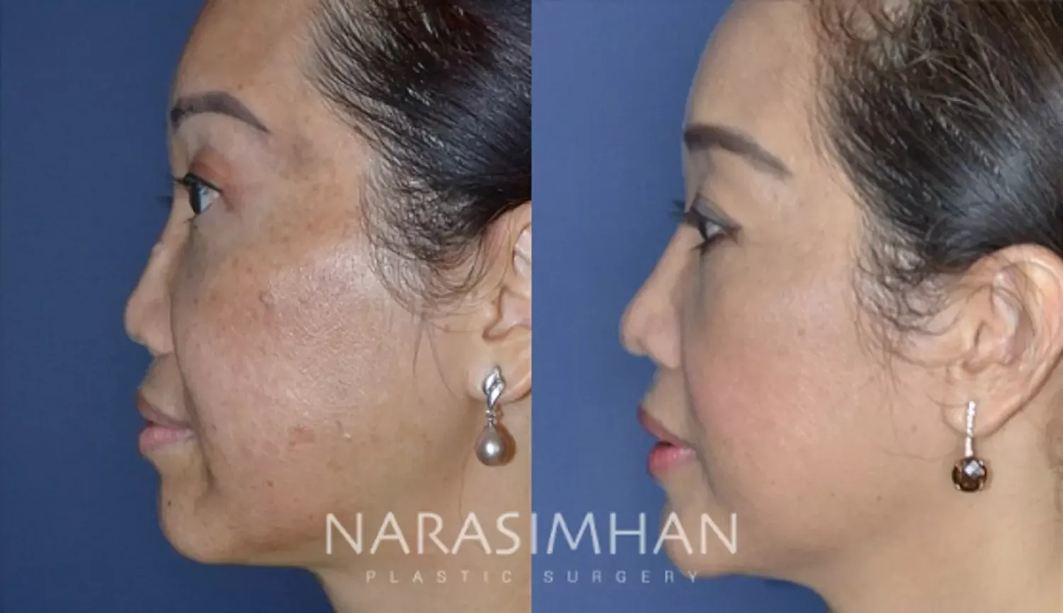 Revision Rhinoplasty Before & After