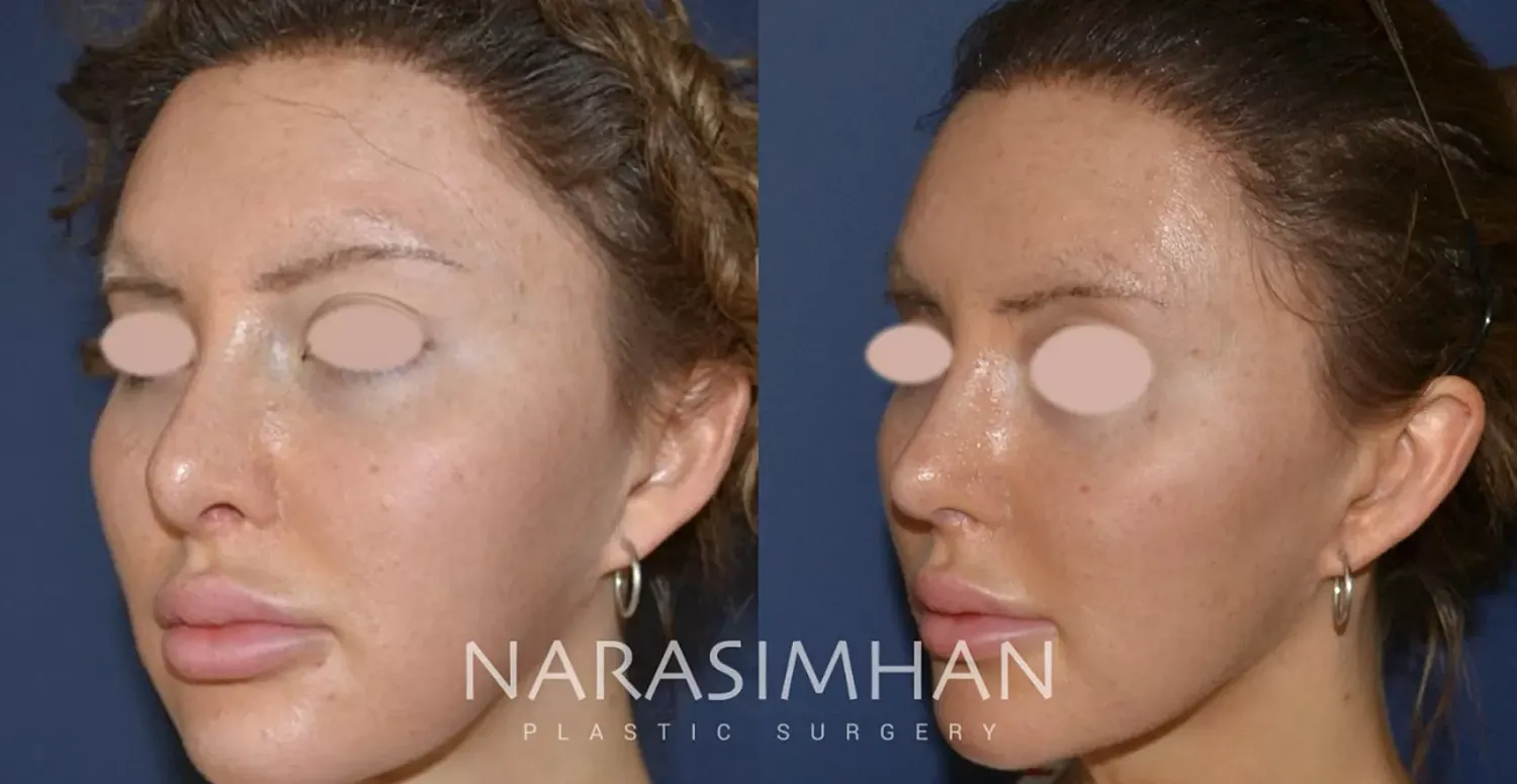 Revision Rhinoplasty Before & After