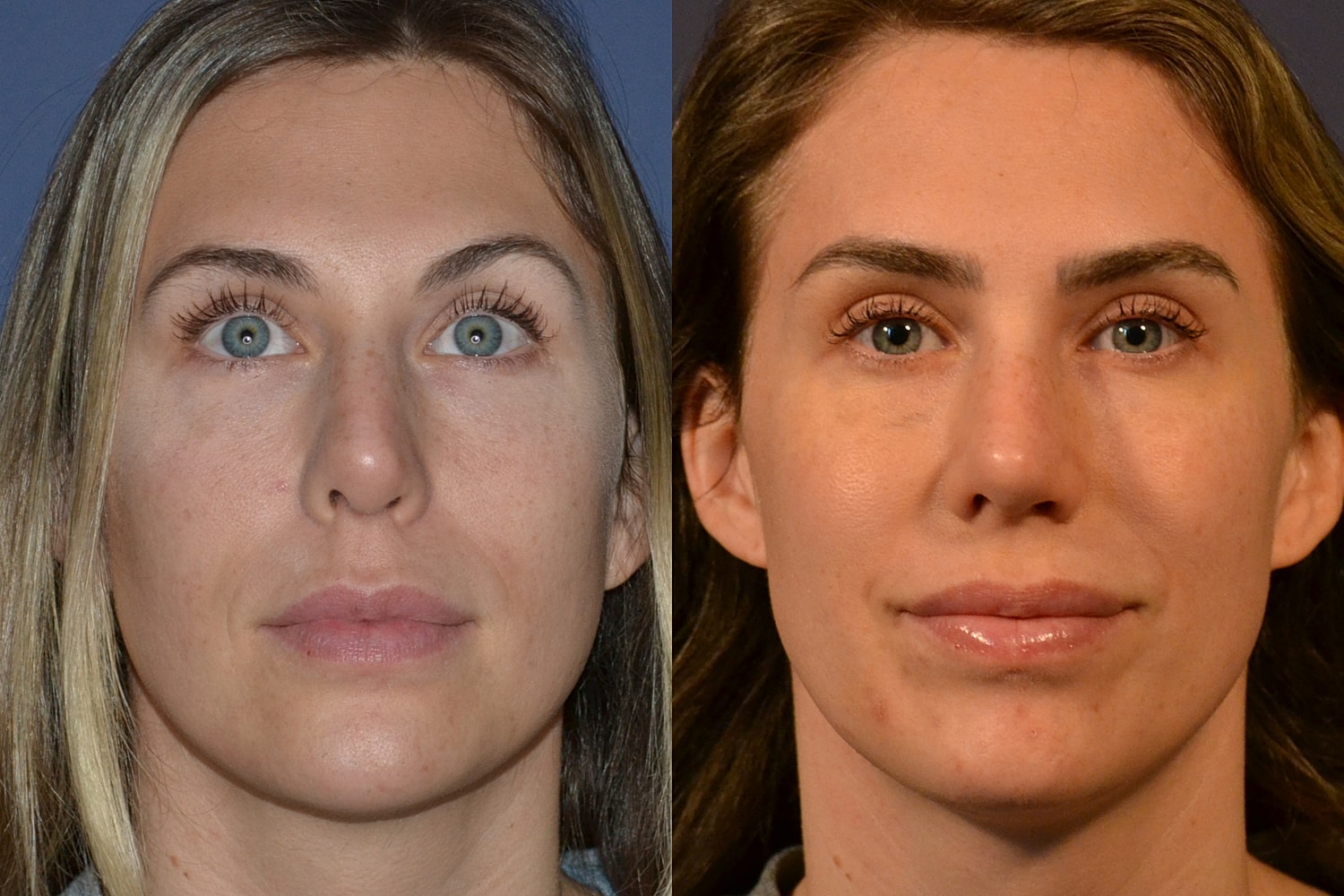 Revision Rhinoplasty Before & After
