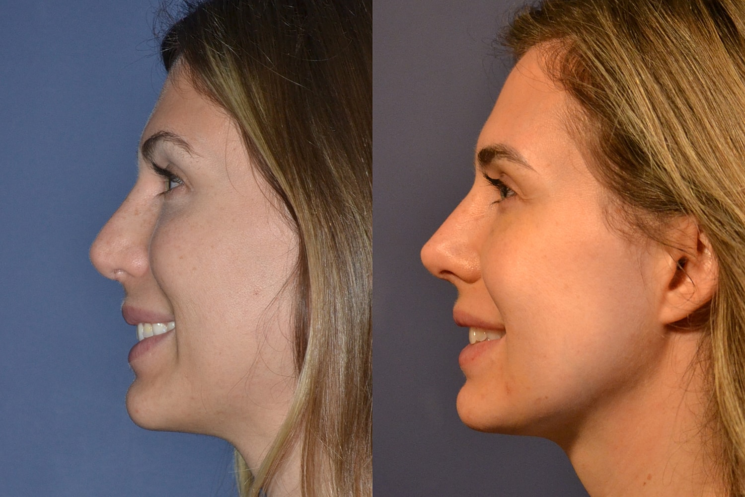 Revision Rhinoplasty Before & After