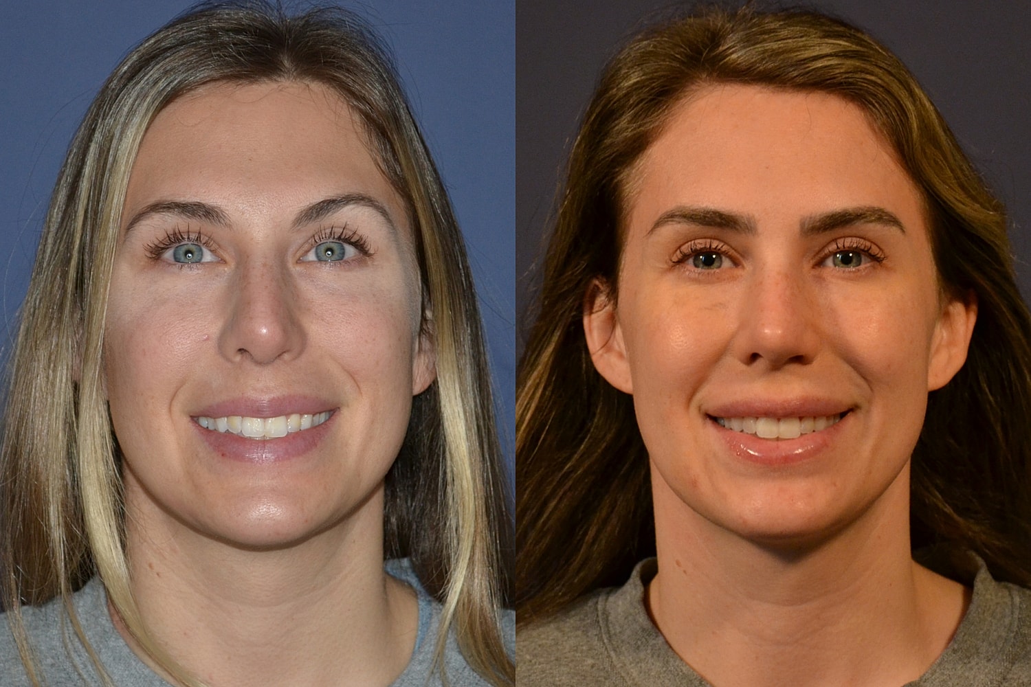 Revision Rhinoplasty Before & After