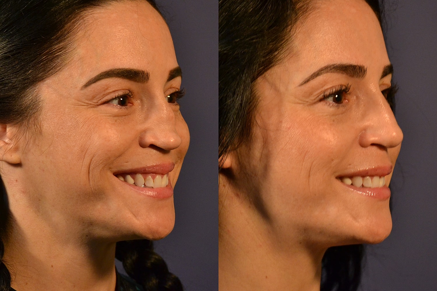 Revision Rhinoplasty Before & After