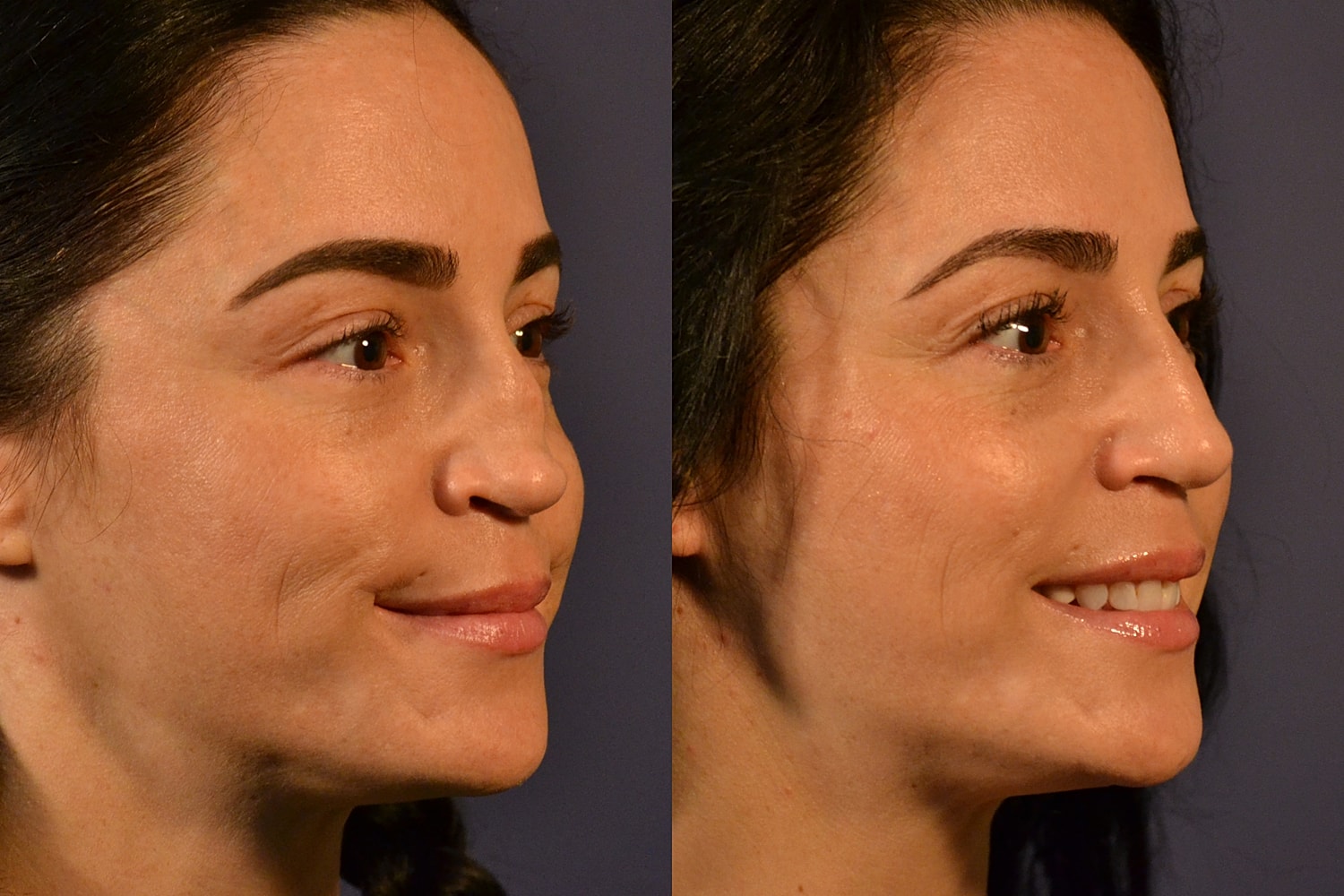 Revision Rhinoplasty Before & After