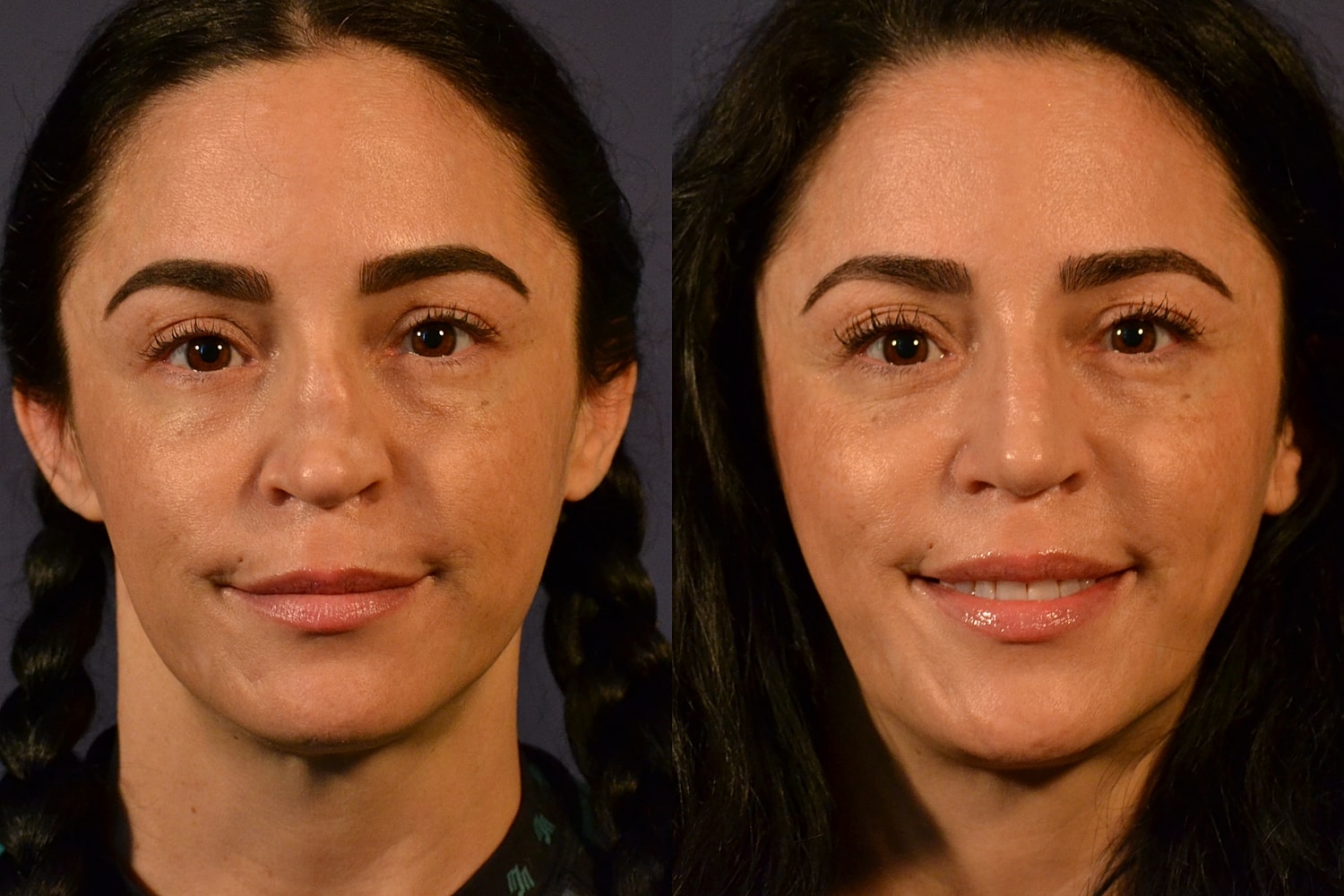 Revision Rhinoplasty Before & After