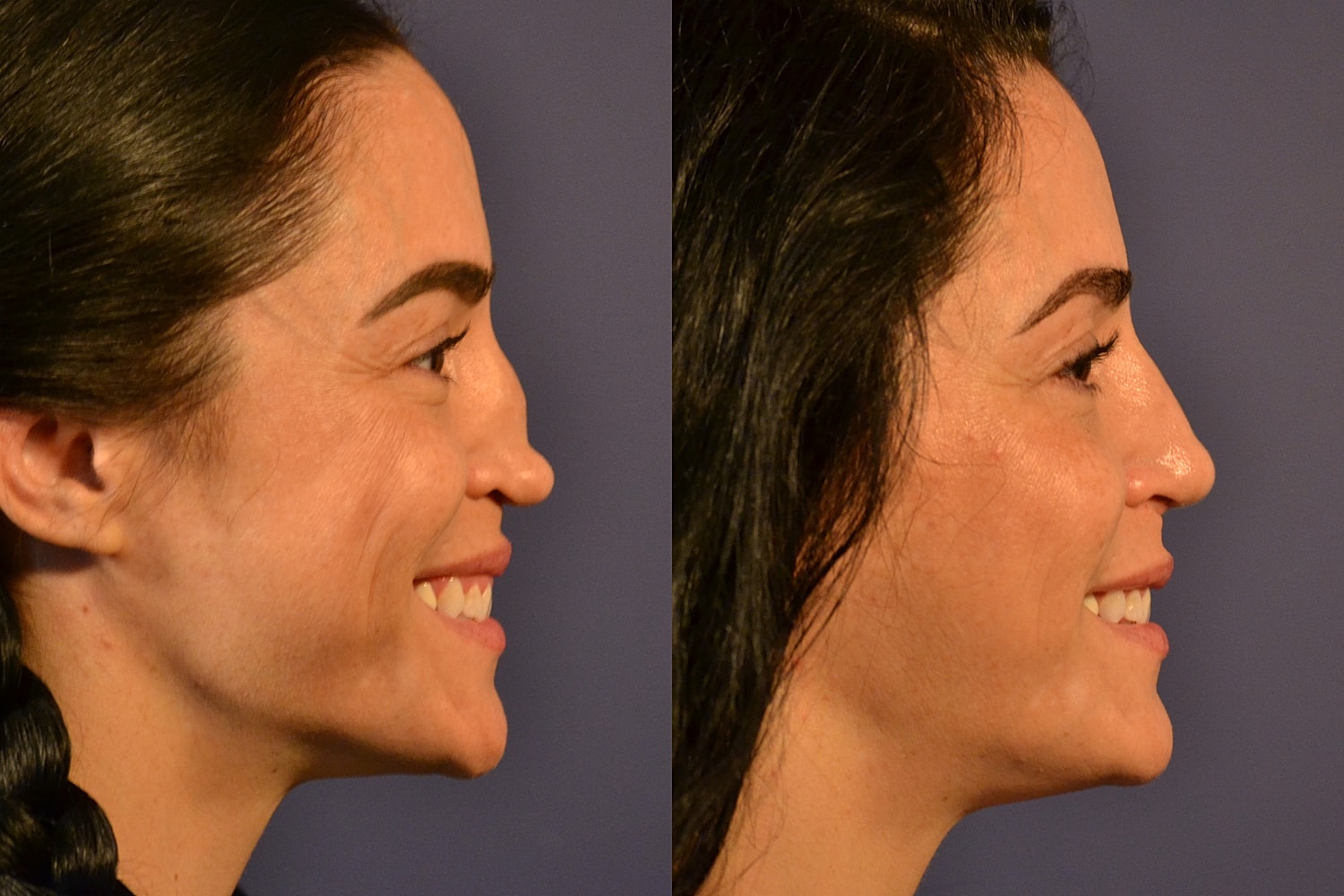 Revision Rhinoplasty Before & After