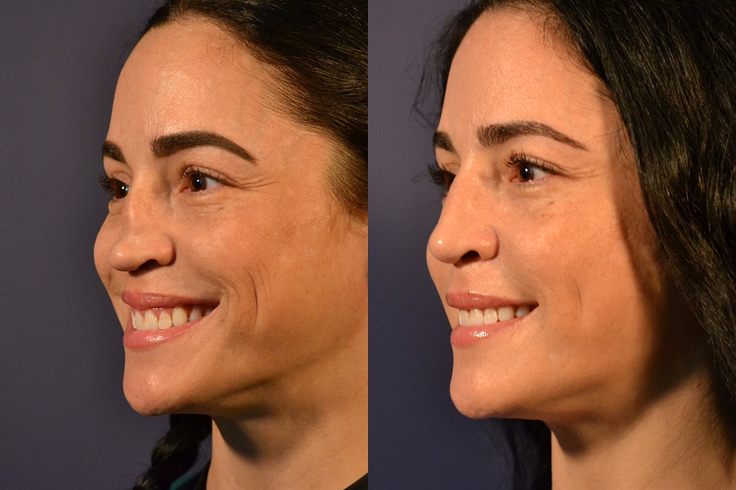 Revision Rhinoplasty Before & After