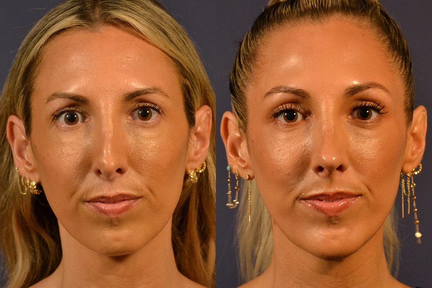 Before and after facial transformation comparison.