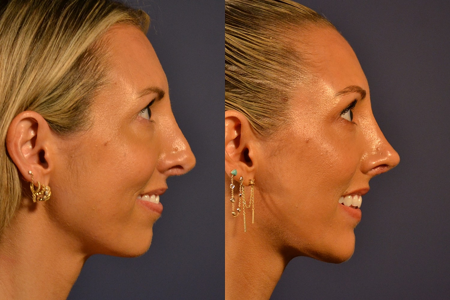 Profile comparison of a woman with earrings.