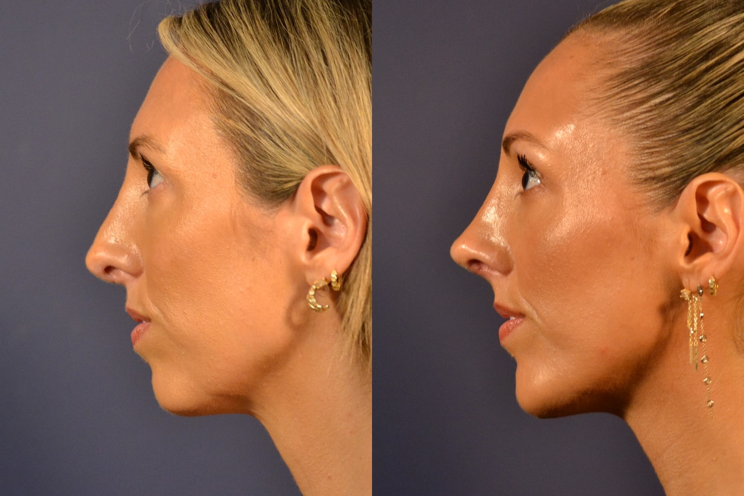 Revision Rhinoplasty Before & After