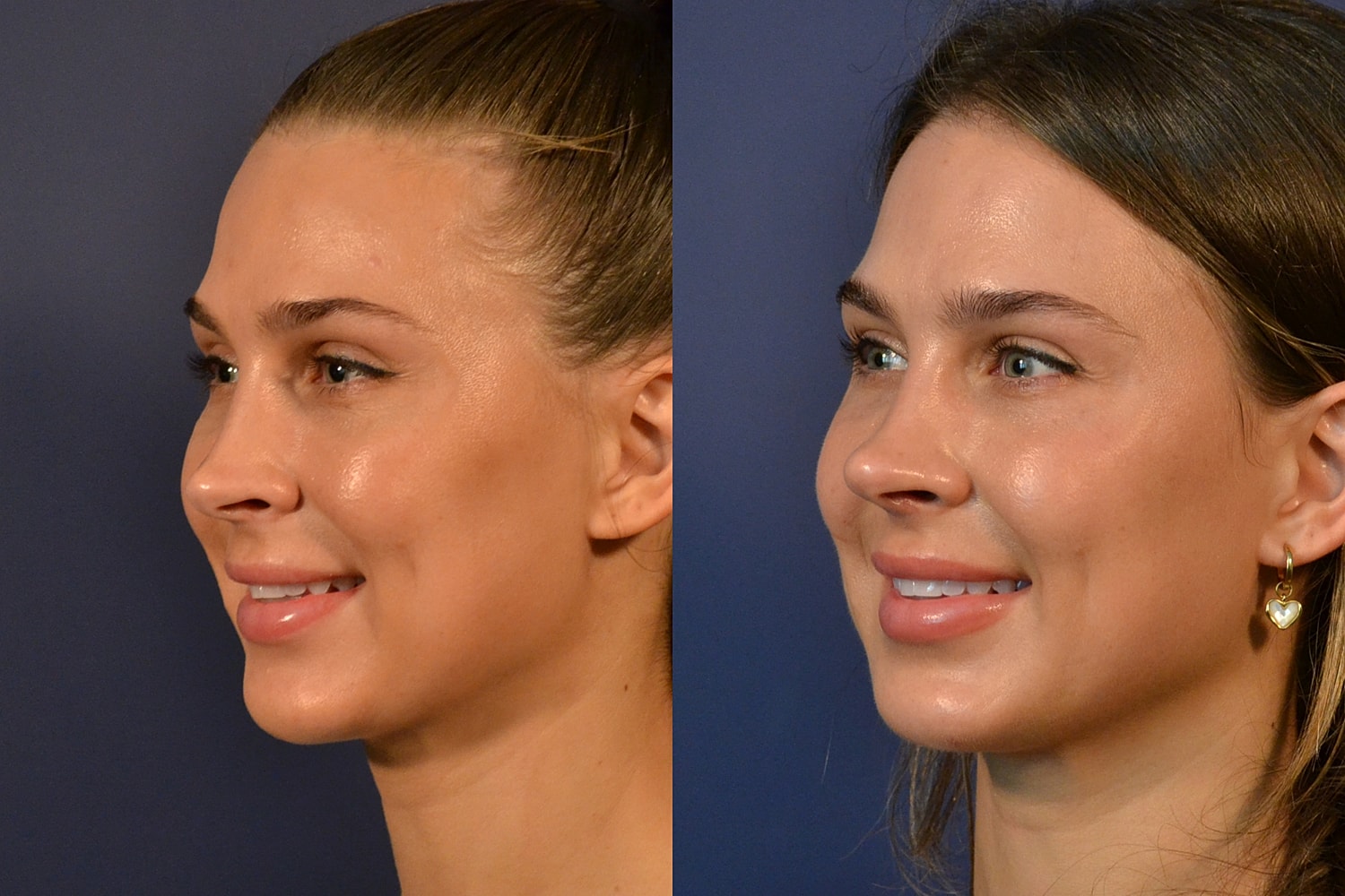 Revision Rhinoplasty Before & After