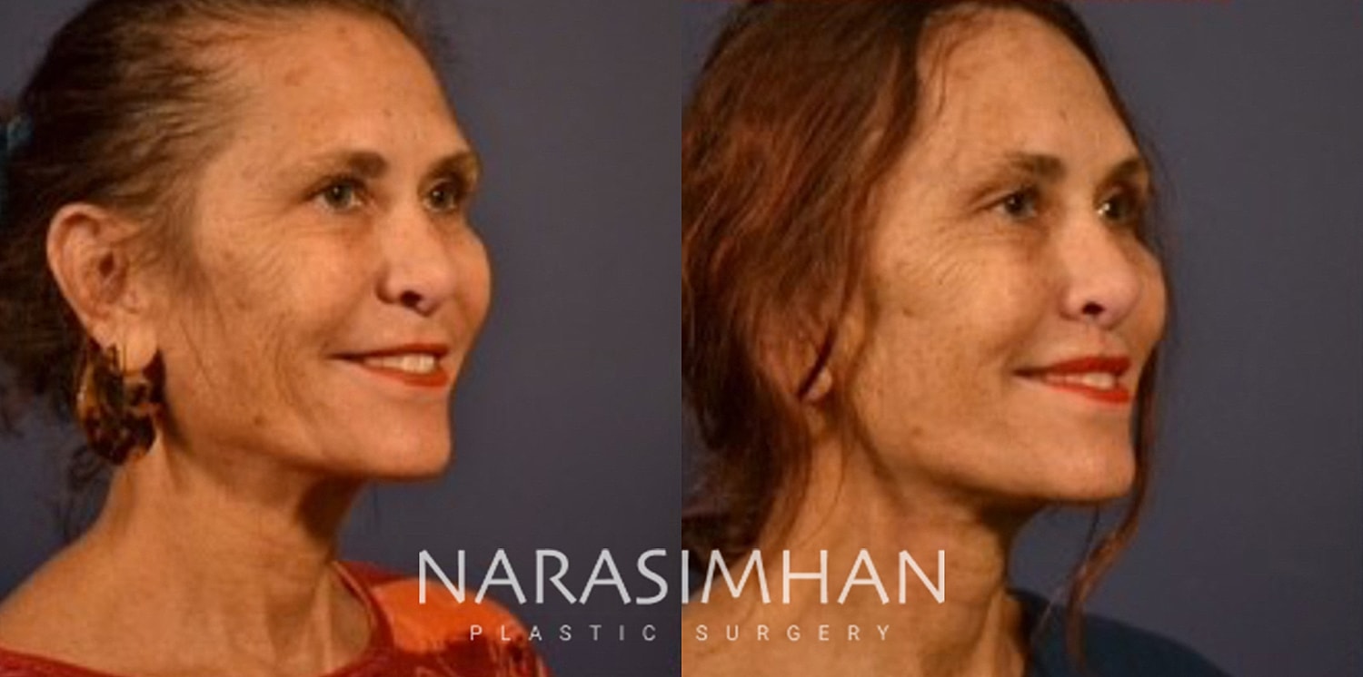 Neck Lift Before & After
